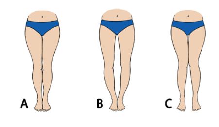 Looking for a Permanent Remedy for Bow Legs – WITHOUT the Need for Surgery?