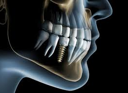 Dental Implants Bundoora
