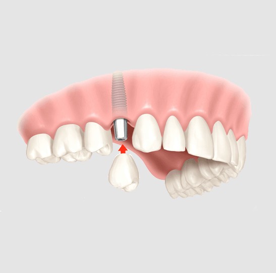 Restore Your Smile with Dental Implants in Bundoora