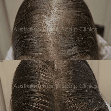Get Your Confidence Back with Hair Loss Treatment in Brisbane